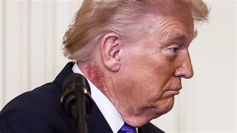 donald trump sparks fresh health concerns  scabbing neck rash