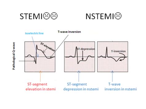 Acute Coronary Syndrome MI Flashcards Quizlet