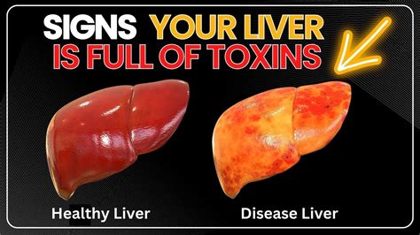 10 Signs Your Liver Is Full Of Toxins Youtube