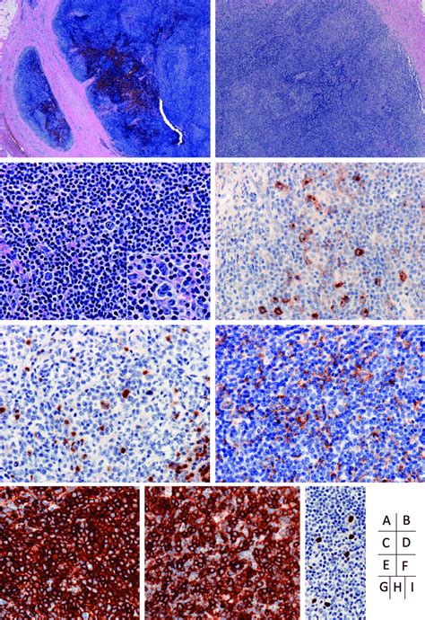 Follicular T-cell lymphoma morphology resembles lymphocyte-rich classic... | Download Scientific ...