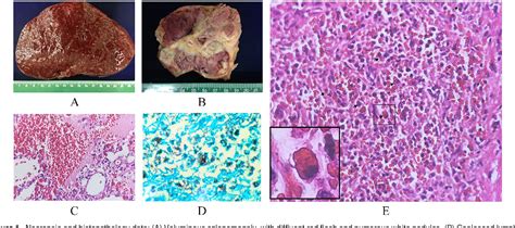 Figure From Hemophagocytic Syndrome In A Patient With Hiv And