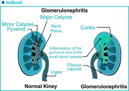 Understanding Nephritis: Types, Symptoms, and Treatment