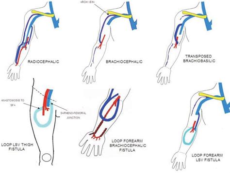 Av Fistula Ultrasound Worksheet