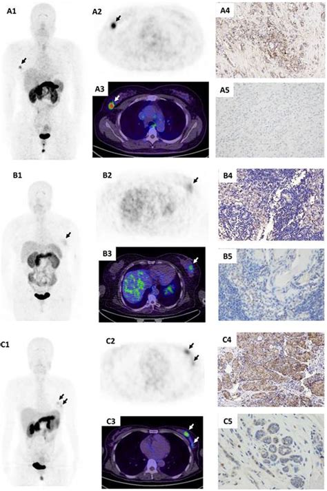 Ga Bbn Rgd Pet Ct For Grpr And Integrin V Imaging In Patients With