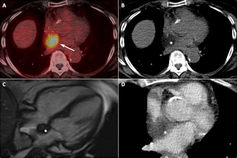 Positron Emission Tomography Imaging In Cardiovascular Disease Heart