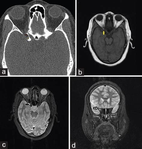 Inferior Orbital Fissure Radiology