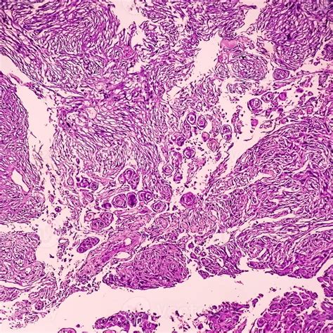 Histology, Peritoneal inclusion cyst. Paraovarian cysts, hydrosalpinx ...