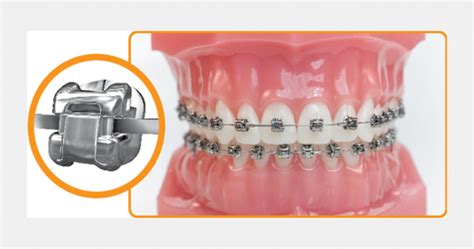 Вестибулярные брекеты. Исправление прикуса быстро и эффективно. Фото ...