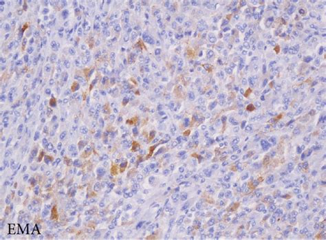 Dural Based High Grade Sarcoma Without Differentiating Features A