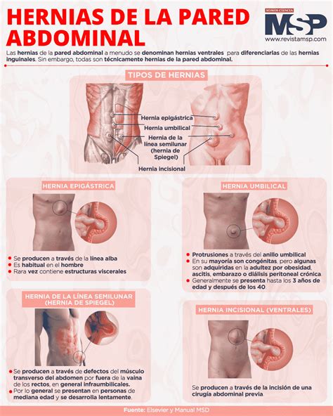 Presupuesto Asistencia Eficiente Anatomia De Las Hernias Inguinales