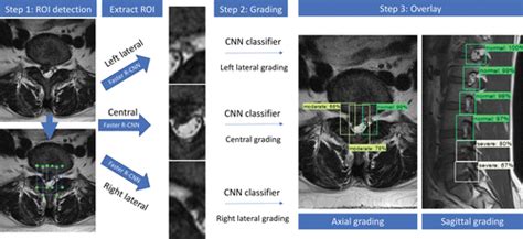 Deep Learning Model For Automated Detection And Classification Of