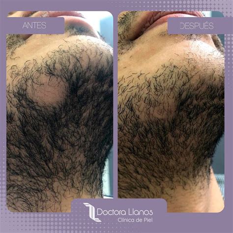 Tratamiento Caída Pelo Bogotá Dermatóloga Lina Llanos