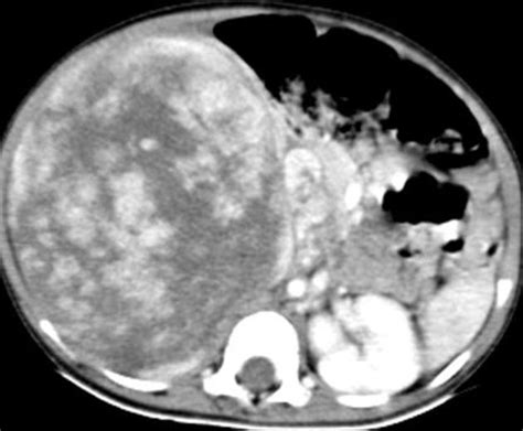 Paediatric Renal Tumours And Masses Pacs