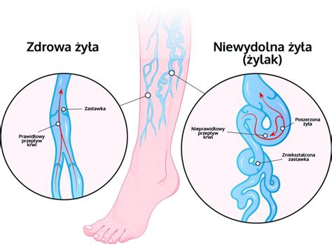 Flebologia Klinikamedyk Szczecin Leczenie żylaków kończyn dolnych