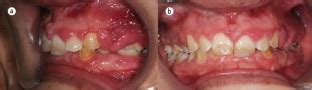 Gingival Overgrowth Part 1 Aetiology And Clinical Diagnosis British