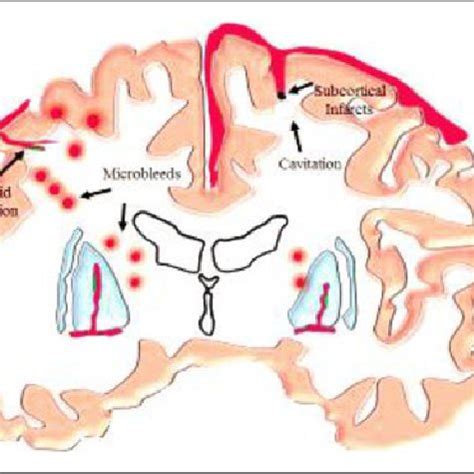 Occlusion Of The Vessel Lumen Is Represented And Acute Ischemia Due To