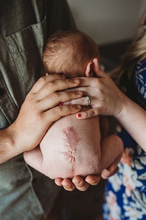 Mom and Baby Thriving After Open Fetal Surgery for Spina Bifida at 25