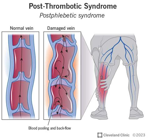 Post Thrombotic Syndrome Symptoms And Treatment