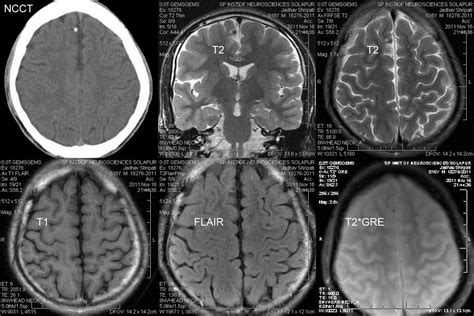 Dr Balaji Anvekar FRCR: Calcified Granuloma CT vs MRI Brain