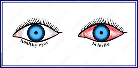 Sclerite. Inflammatory disease of sclera. Stock Vector | Adobe Stock
