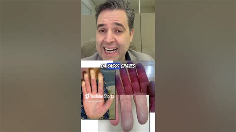 Pontas Dos Dedos Roxas - As pontas dos dedos ficam roxas no frio? - YouTube