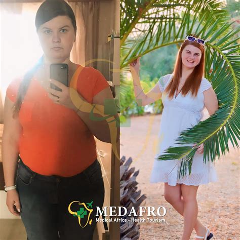 Obesity Treatment Gallery - Health in Turkey