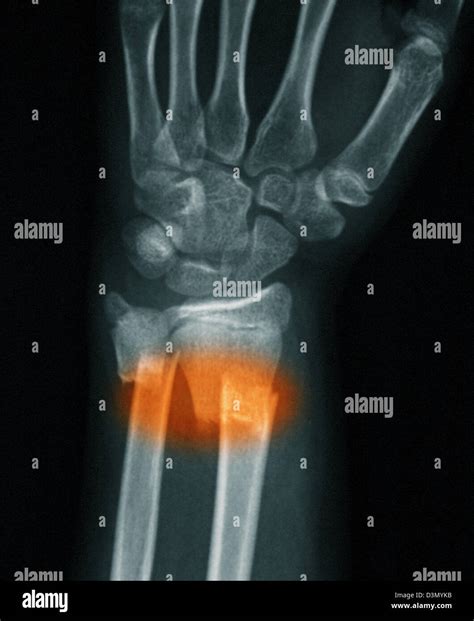 Radius And Ulna X Ray