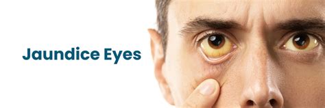 Jaundice Eyes Causes Symptoms And Treatments