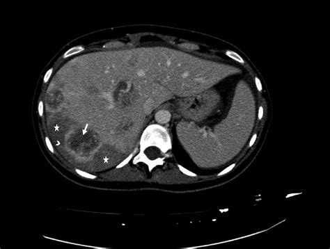 Hepatic Metastasis Necrotic Hemorrhagic Degeneration Axial