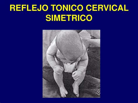 Reflexo Tônico Cervical Simétrico