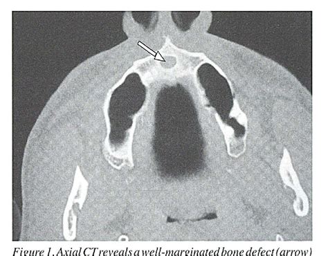 Figure I From Nasopalatine Duct Cyst Semantic Scholar