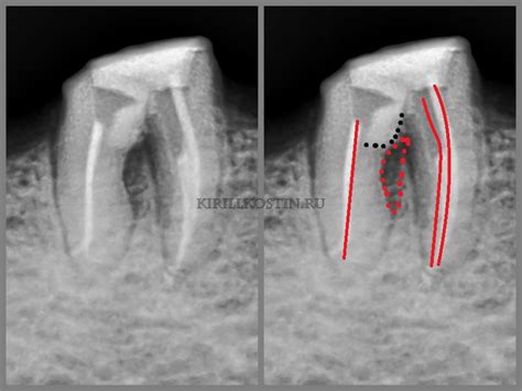 Дырка В Зубе Фото – Telegraph