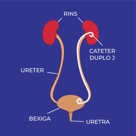 Para Que Serve Duplo J - Cateter Duplo J - Dr Francisco Marconato
