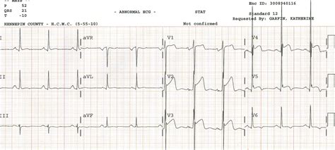 Dr. Smith's ECG Blog: October 2016