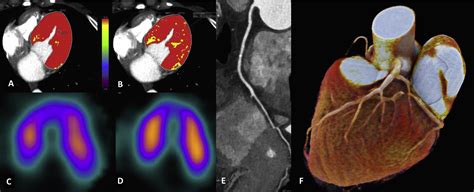 Dynamic Ct Myocardial Perfusion Imaging European Journal Of Radiology