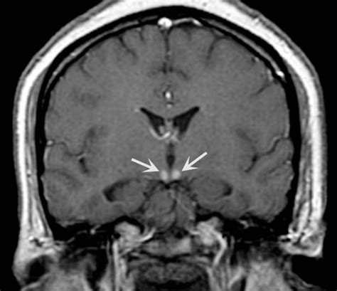 Wernicke Korsakoff Syndrome Neurology Medbullets Step 1