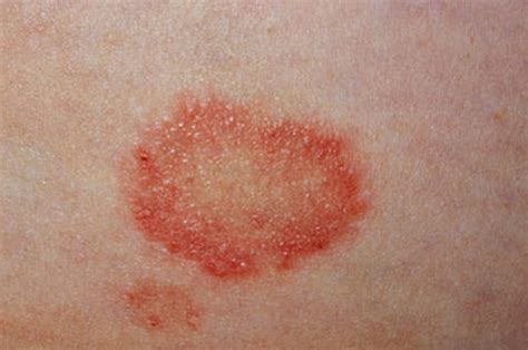 Ringworm – Images, Causes, Symptoms, Treatment | HubPages