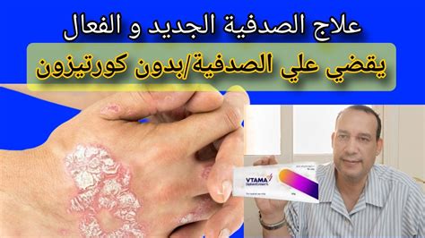 علاج الصدفية الجديد بدون كورتيزون يعيد الجلد الي شكله الطبيعي Youtube