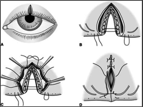 Surfing Medicine Case Report Eye Trauma From A Surfboard