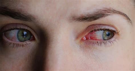 Pink Eye Vs Allergies How To Tell The Difference Ivermectinnews