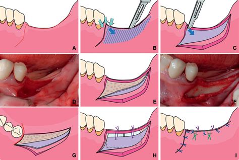 figure   double flap incision design  guided bone regeneration