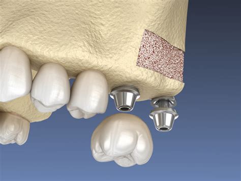 Guided Bone Regeneration Windsor Ct Sinus Lift Bone Grafting