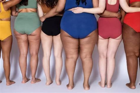 Lipedema Toda la información que debes conocer Virtus Estética