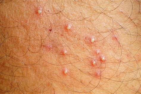 Folliculitis Philippine Dermatological Society Official Website