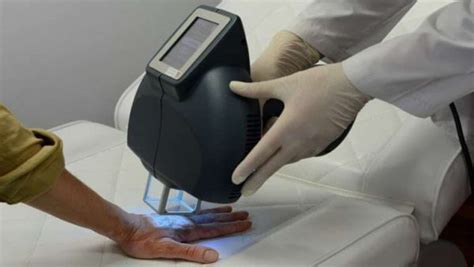 Laser Excimer Dermatología Tricología Y Estética