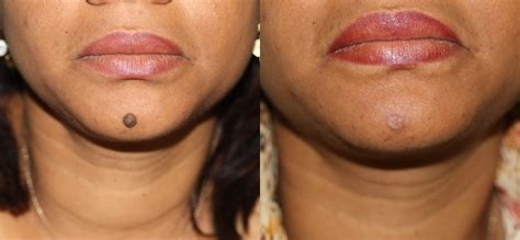 Mole Removal Prices, Costs | Skin Surgery Laser Clinic