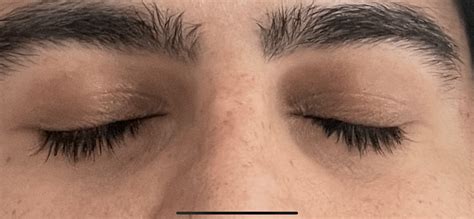 Skin Concerns Really Dark Eyelids Any Recommendations To Lighten Rskincareaddiction