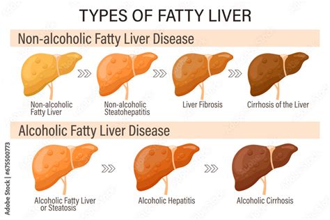 Types Of Fatty Liver Human Liver Diseases Alcoholic And Non Alcoholic