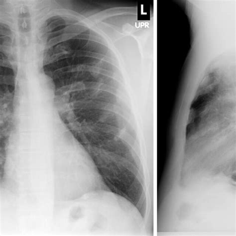 Postero Anterior And Lateral Chest Radiographs Demonstrating Extensive