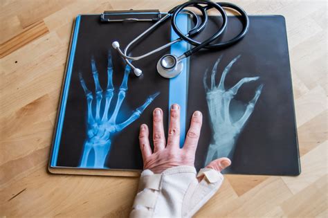 Qual Exame Detecta Artrite E Artrose - Artrite e artrose: diferenças, sintomas e tratamento